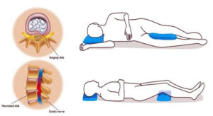 Thoát vị đĩa đệm – Bệnh lý cột sống phổ biến cần được phát hiện sớm